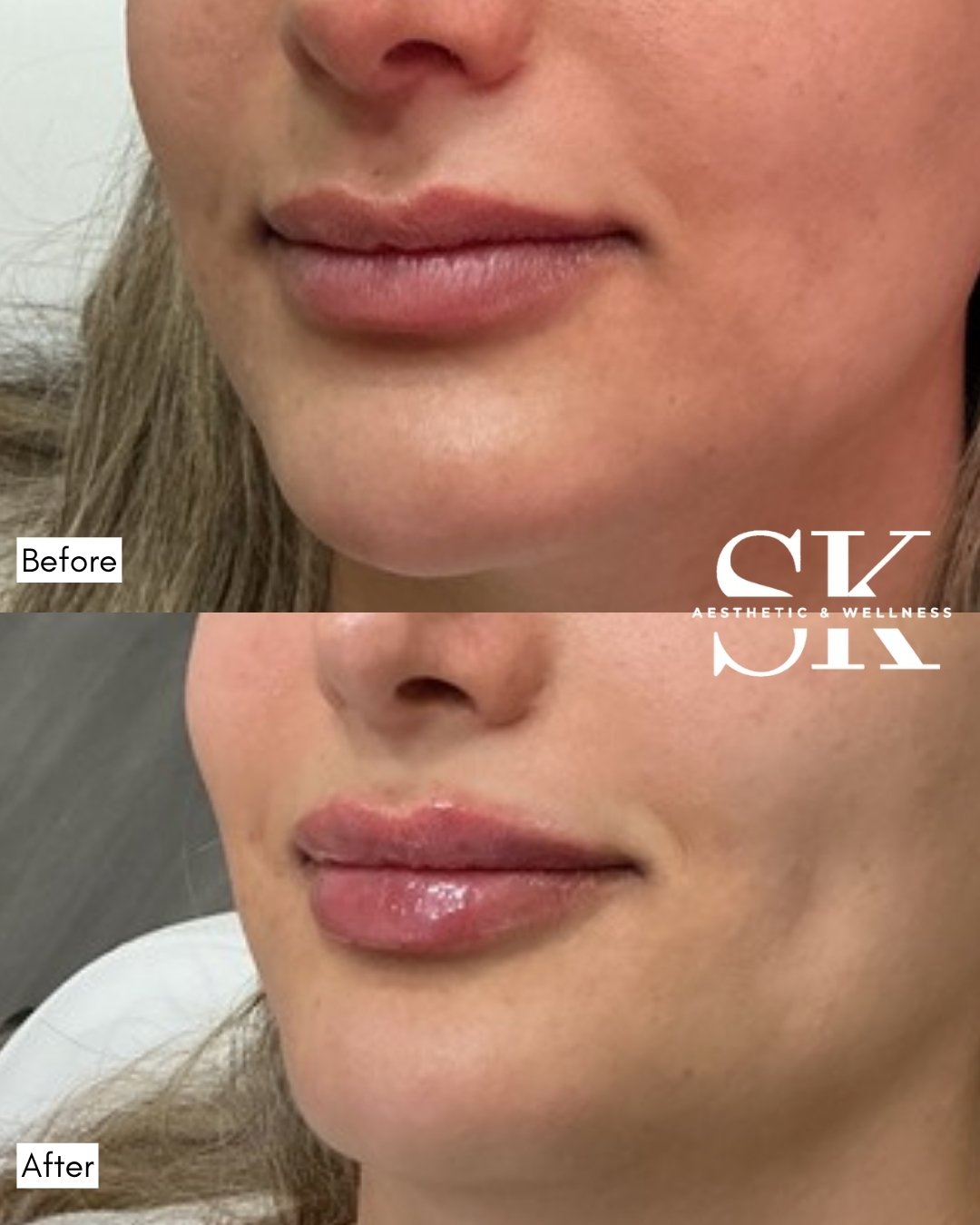 Lip filler before and after — SK Aesthetic and Wellness patient