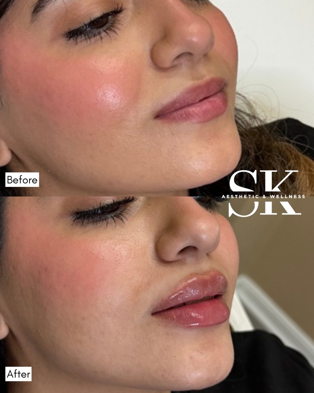 Lip filler before and after — SK Aesthetic and Wellness patient