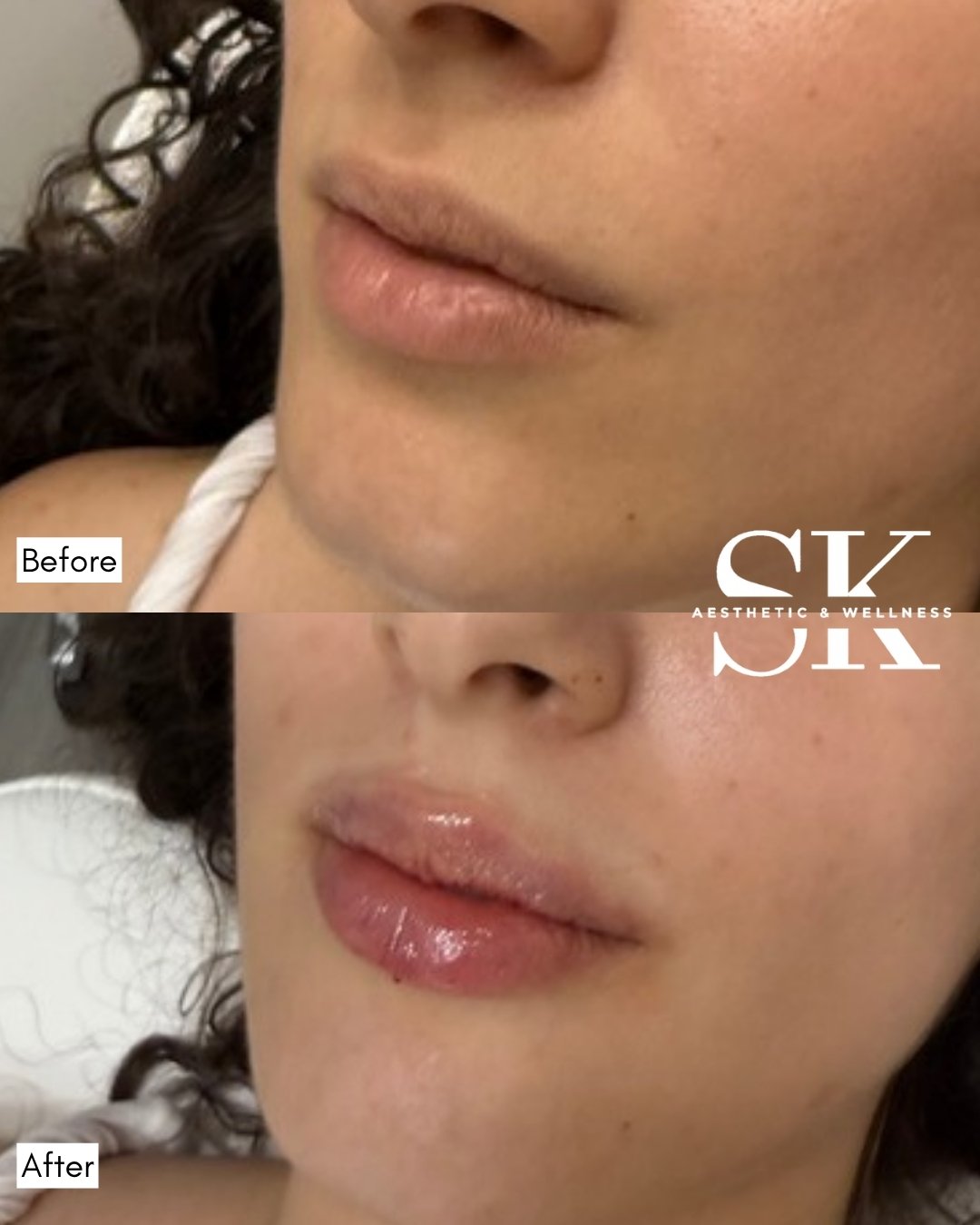 Lip filler before and after — SK Aesthetic and Wellness patient