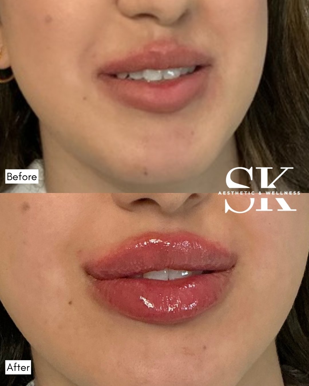 Lip filler before and after — SK Aesthetic and Wellness patient