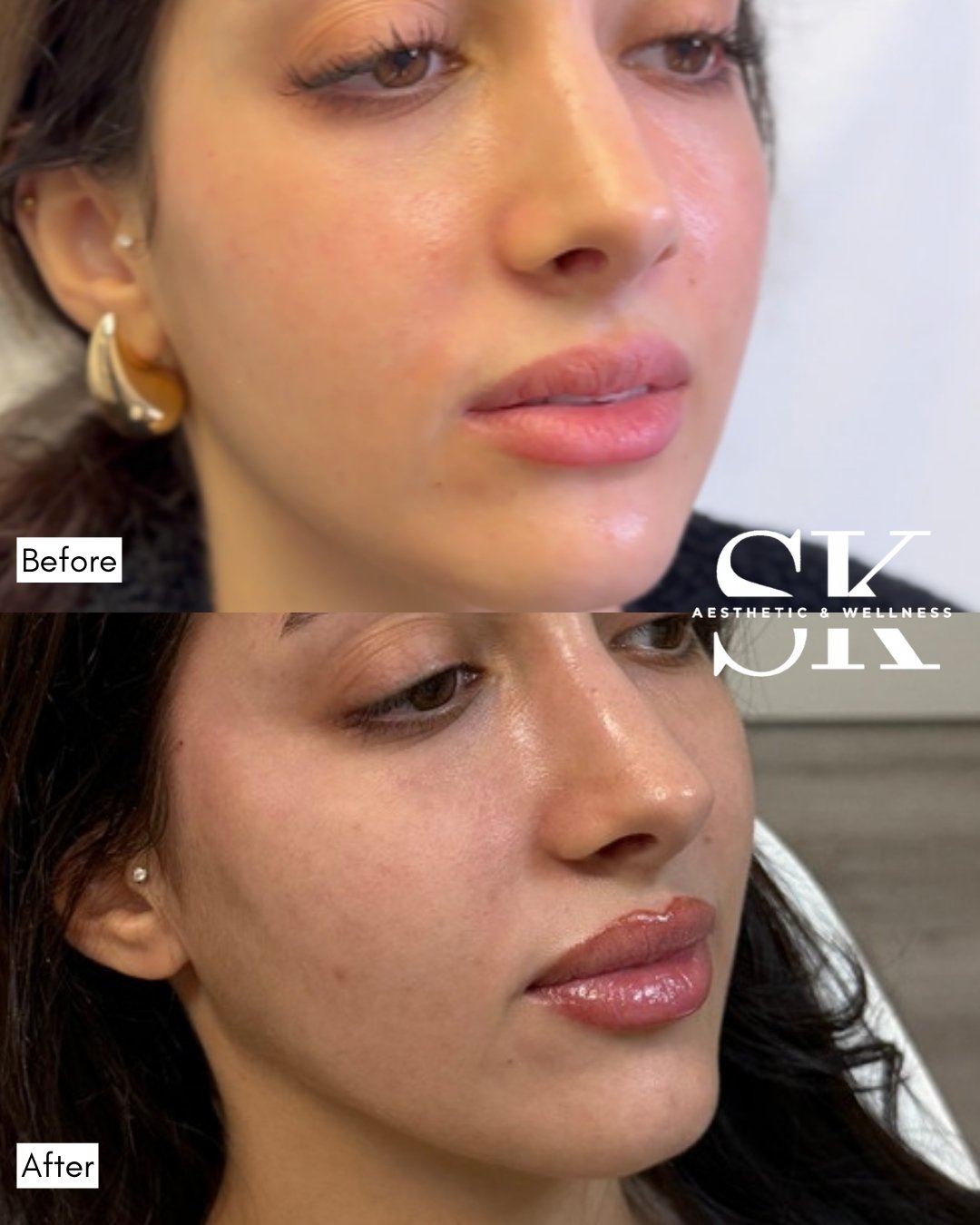 Facial balancing — lips, cheeks, temples before and after — SK Aesthetic and Wellness patient