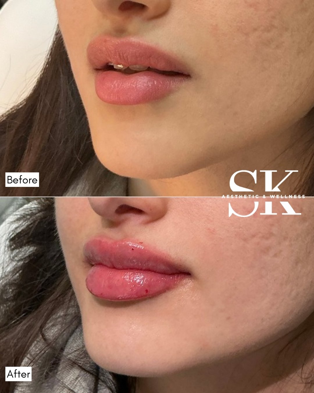 Lip filler before and after — SK Aesthetic and Wellness patient