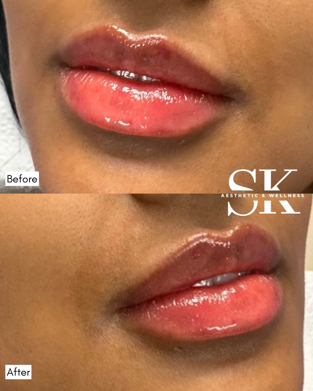 Lip filler before and after — SK Aesthetic and Wellness patient