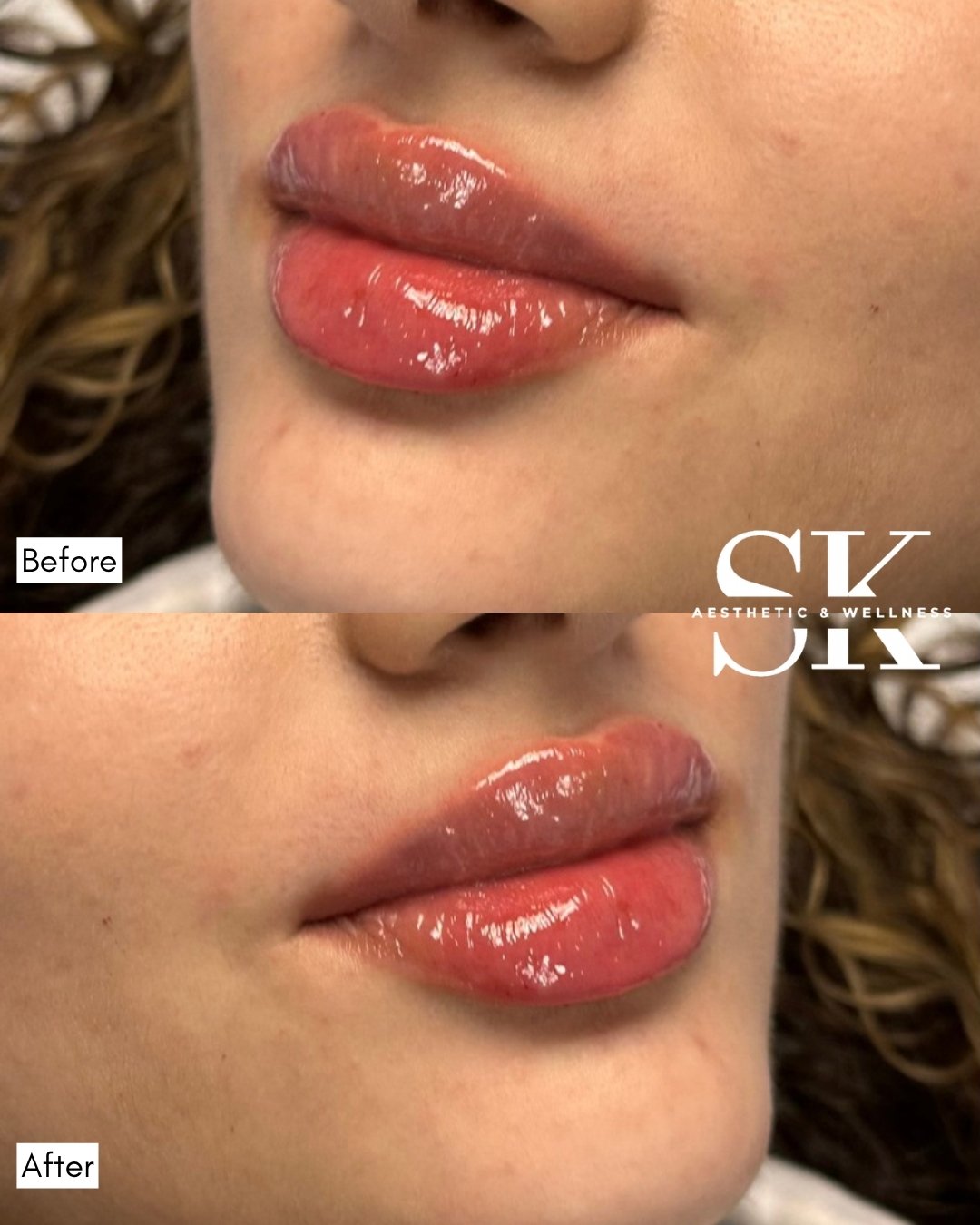 Lip filler before and after — SK Aesthetic and Wellness patient