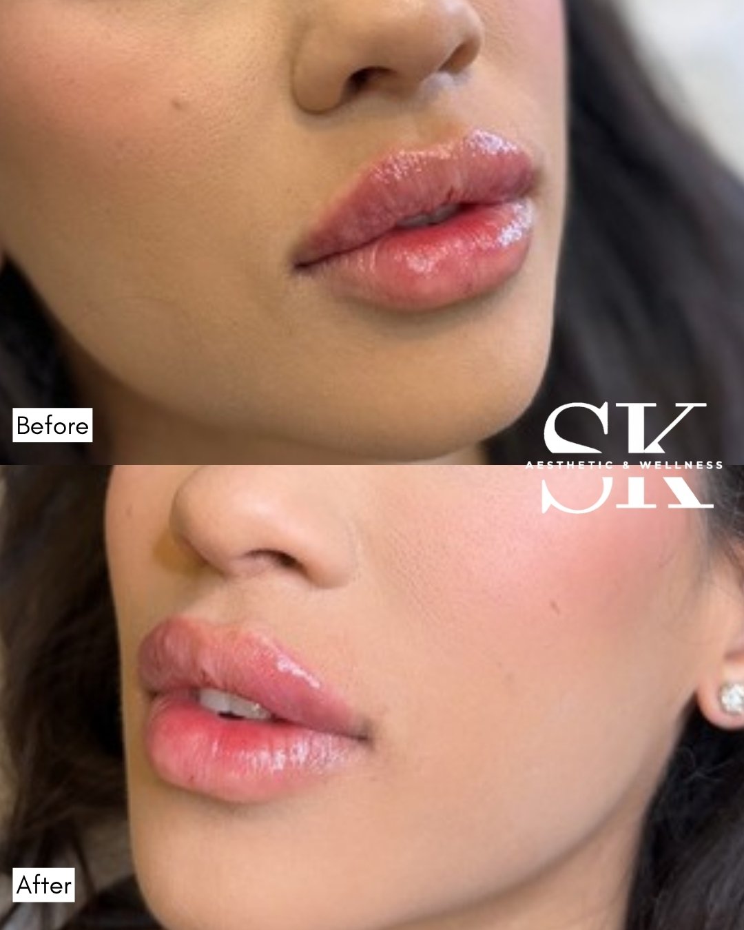 Lip filler before and after — SK Aesthetic and Wellness patient