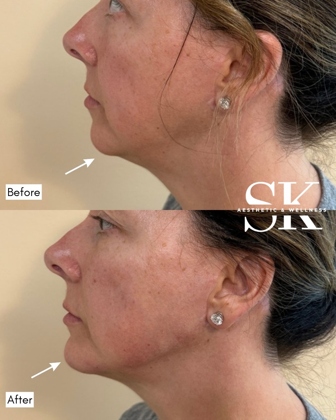 Jaw and chin definition before and after — SK Aesthetic and Wellness patient