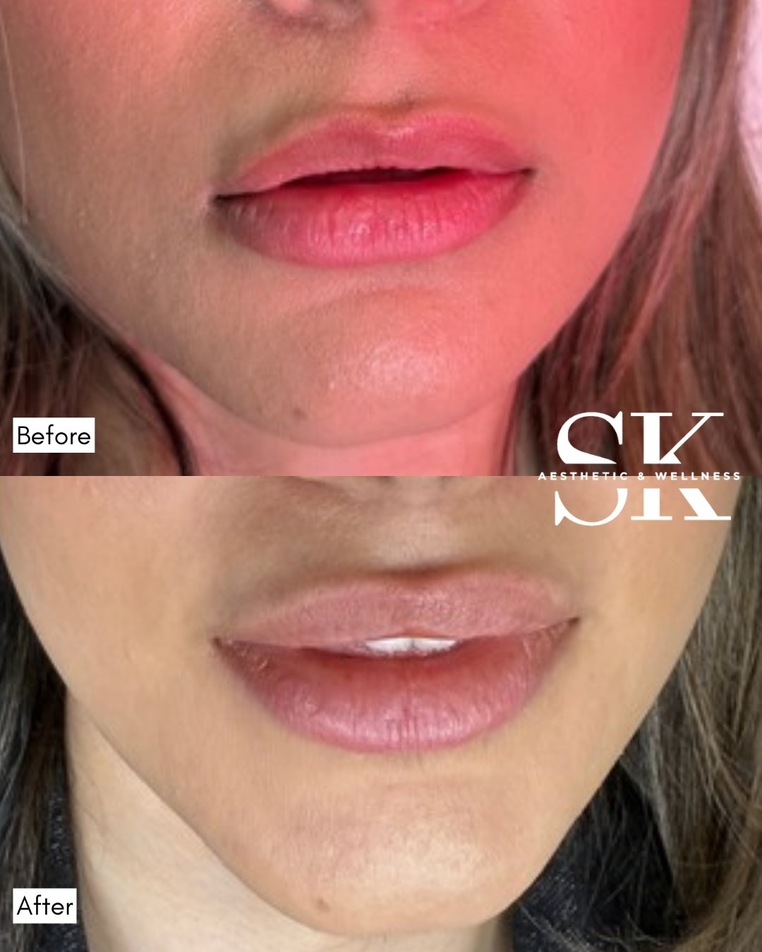 Lip filler before and after — SK Aesthetic and Wellness patient