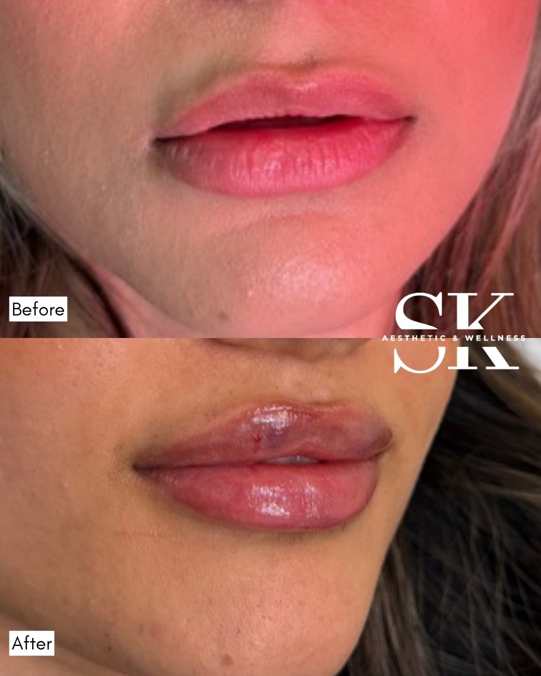 Lip filler before and after — SK Aesthetic and Wellness patient