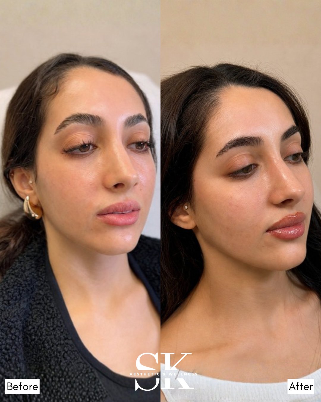 Filler — cheeks, chin, lips before and after — SK Aesthetic and Wellness patient