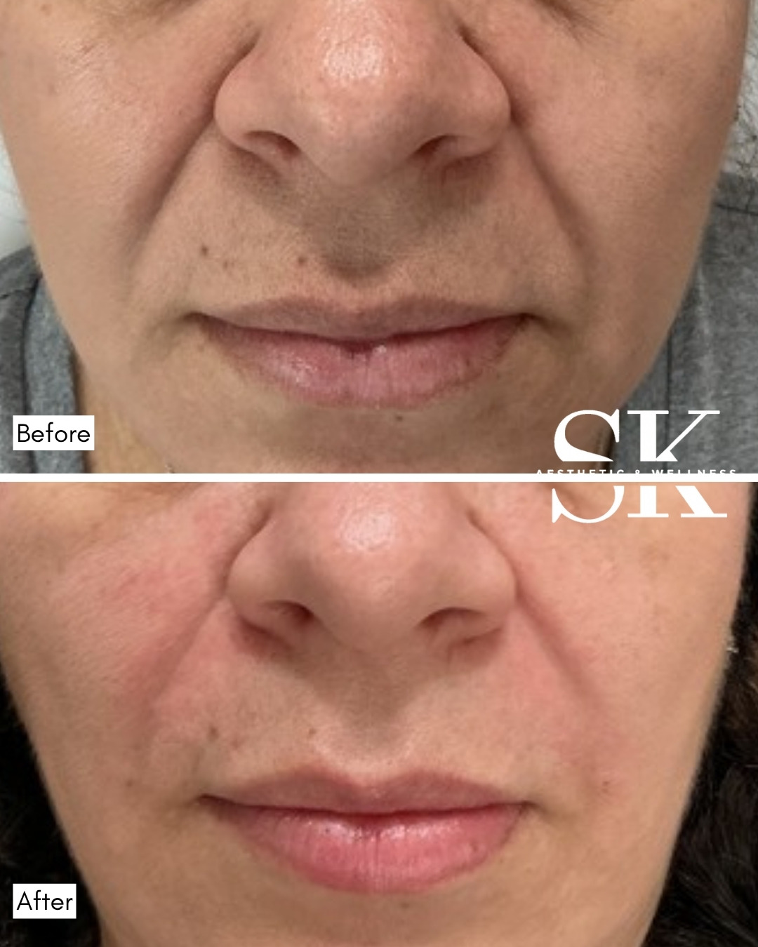 Filler — smile lines before and after — SK Aesthetic and Wellness patient