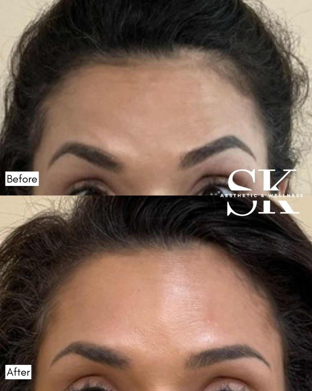 Botox — forehead before and after — SK Aesthetic and Wellness patient