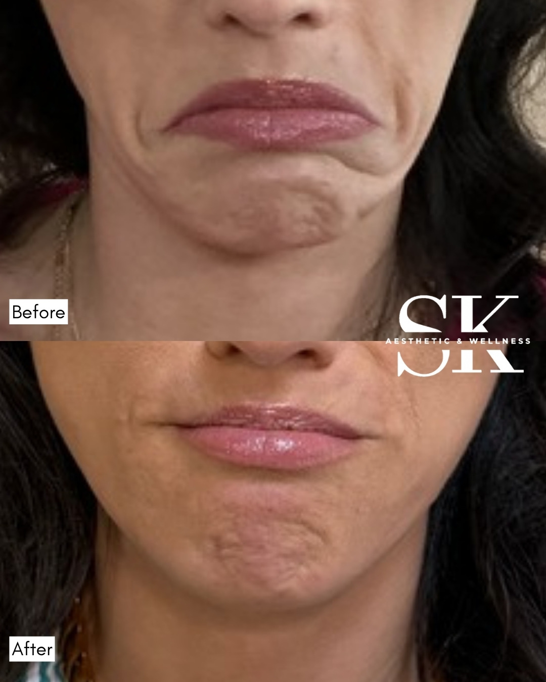 Botox for downturned mouth corners (DAO) before and after — SK Aesthetic and Wellness patient