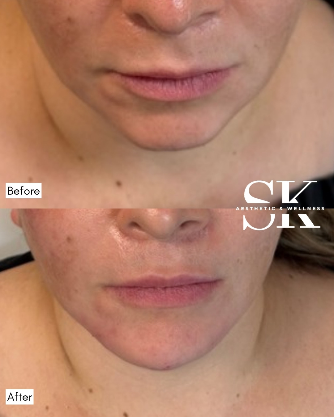 Lower face correction before and after — SK Aesthetic and Wellness patient