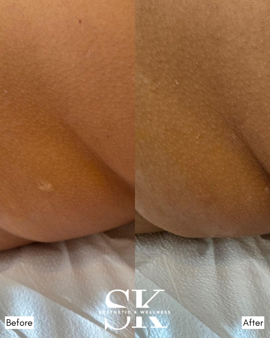 Scar camouflage before and after — SK Aesthetic and Wellness patient
