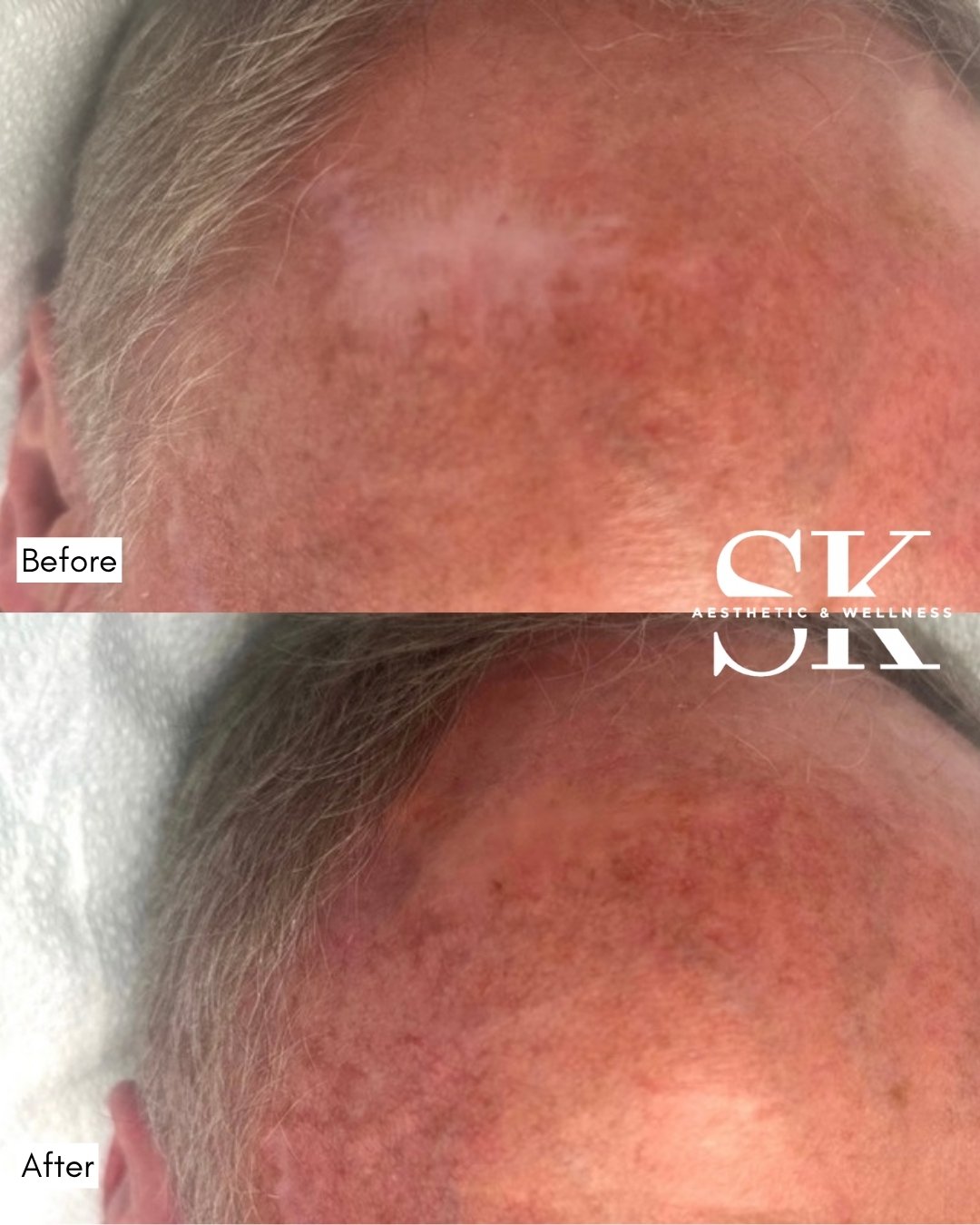 Scar camouflage before and after — SK Aesthetic and Wellness patient