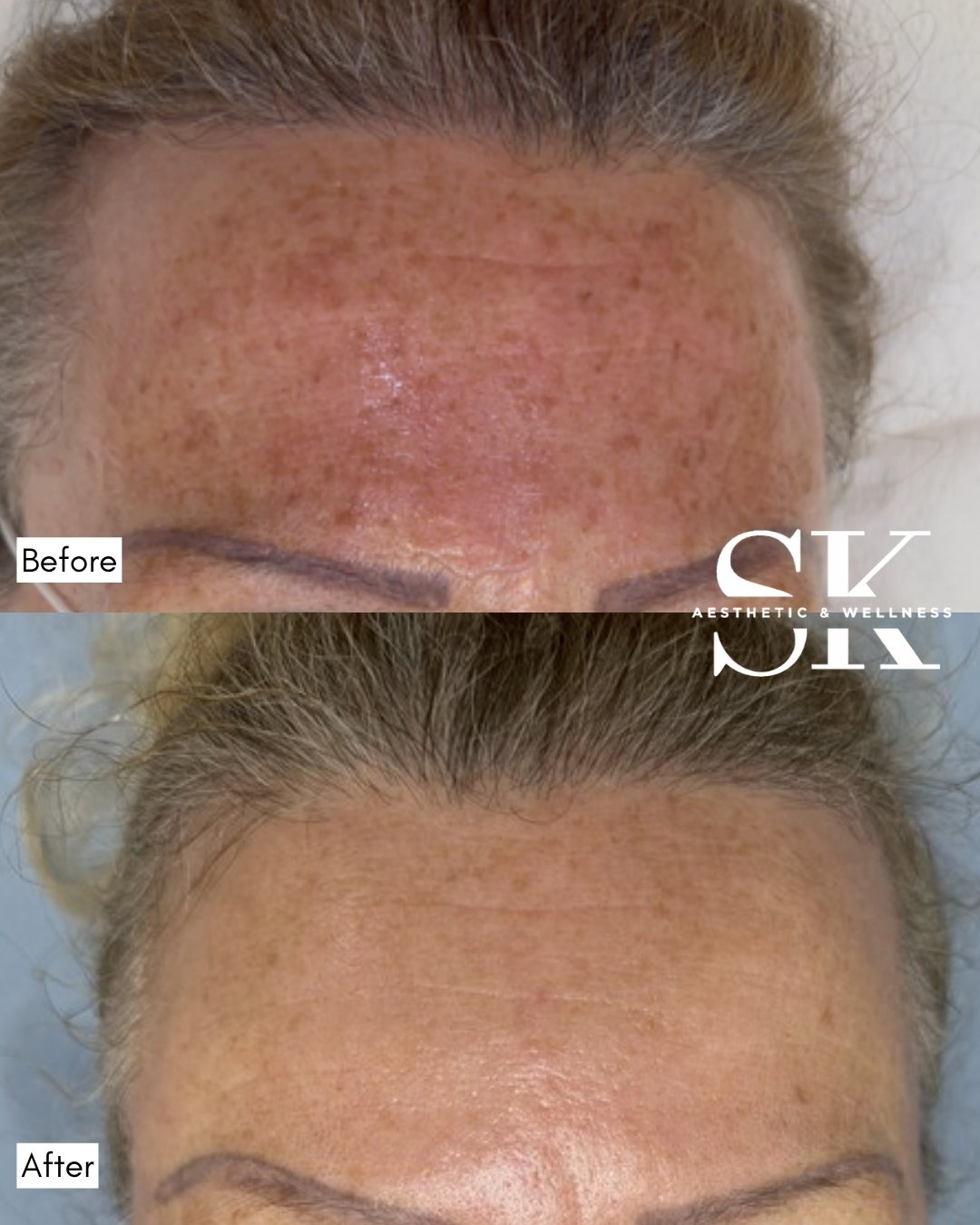 Sun damage correction with BBL and HALO before and after — SK Aesthetic and Wellness patient