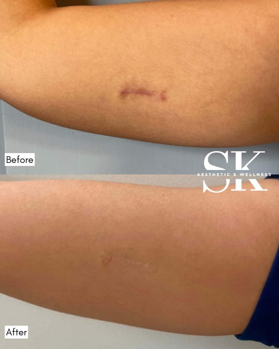 Scar camouflage before and after — SK Aesthetic and Wellness patient