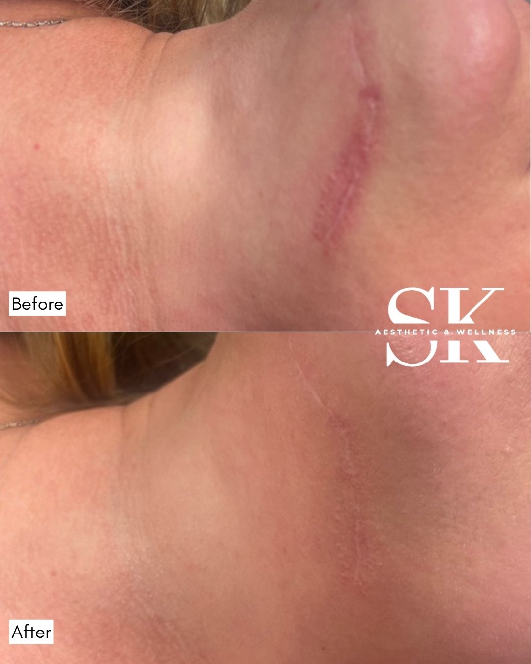 Scar camouflage before and after — SK Aesthetic and Wellness patient