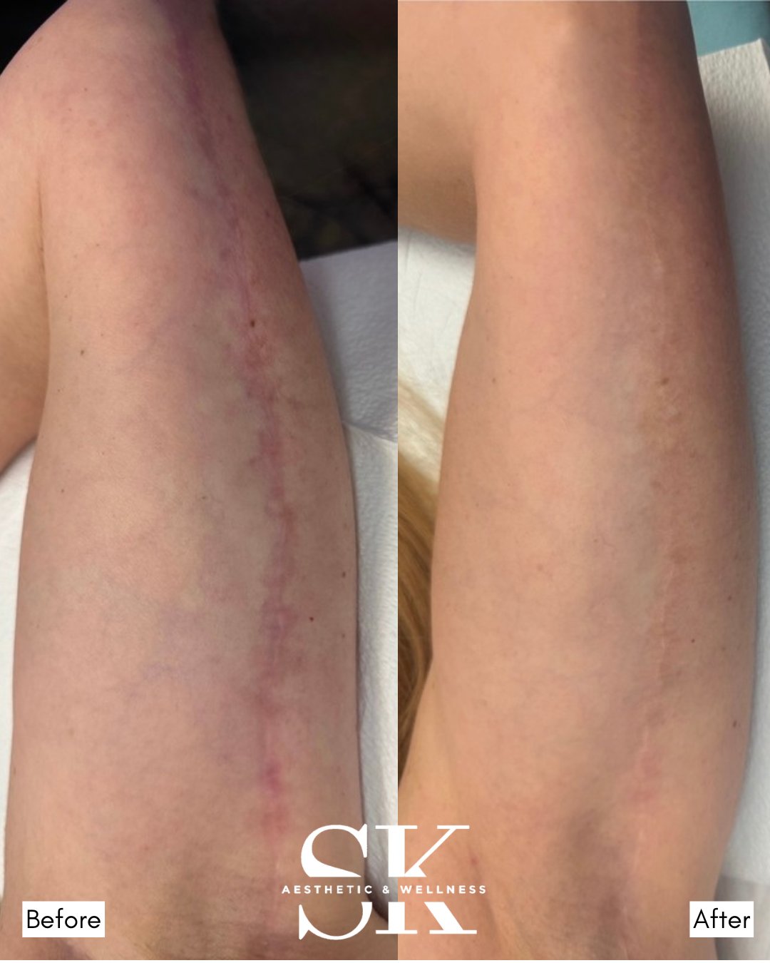 Scar camouflage before and after — SK Aesthetic and Wellness patient