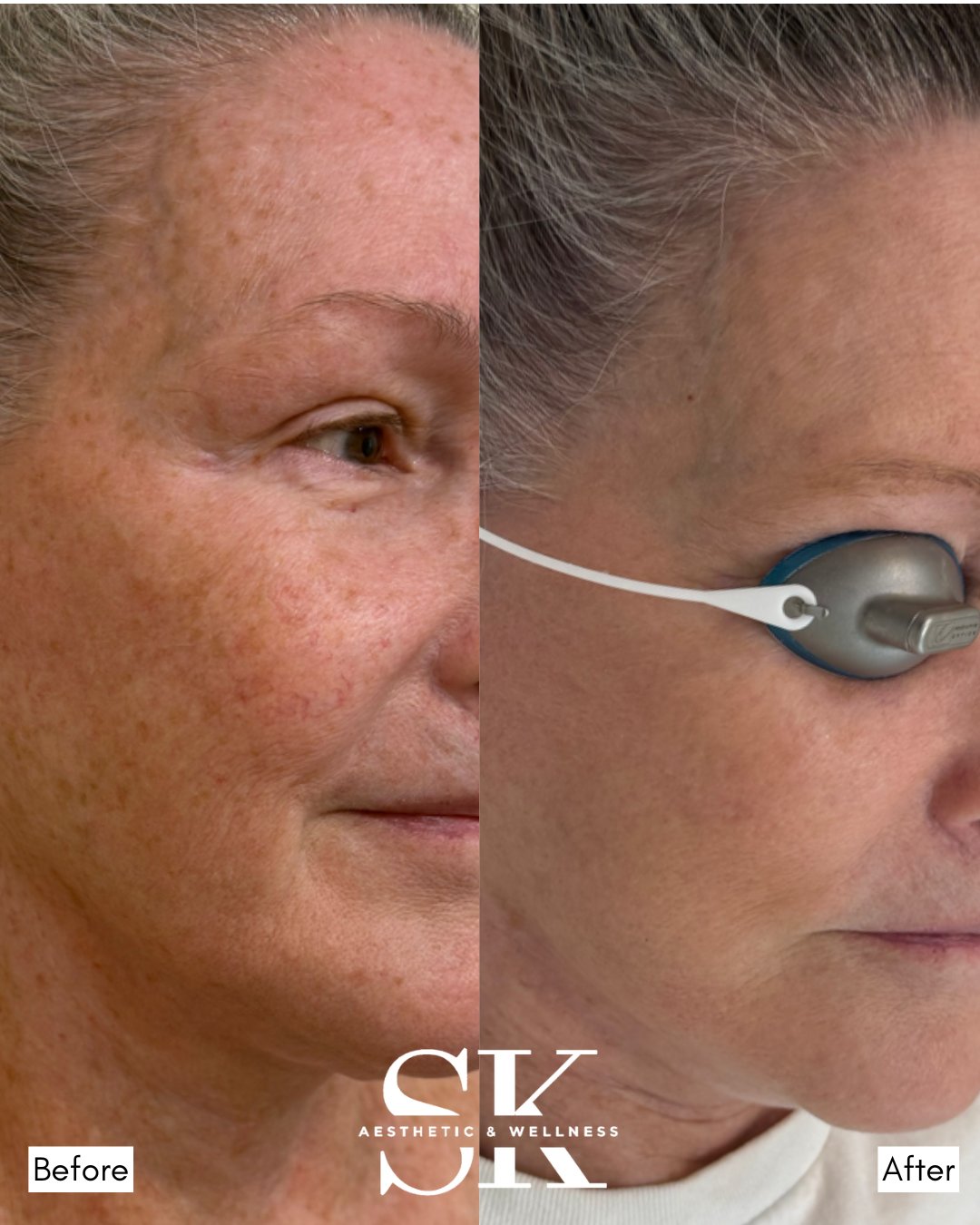 BBL and HALO before and after — SK Aesthetic and Wellness patient