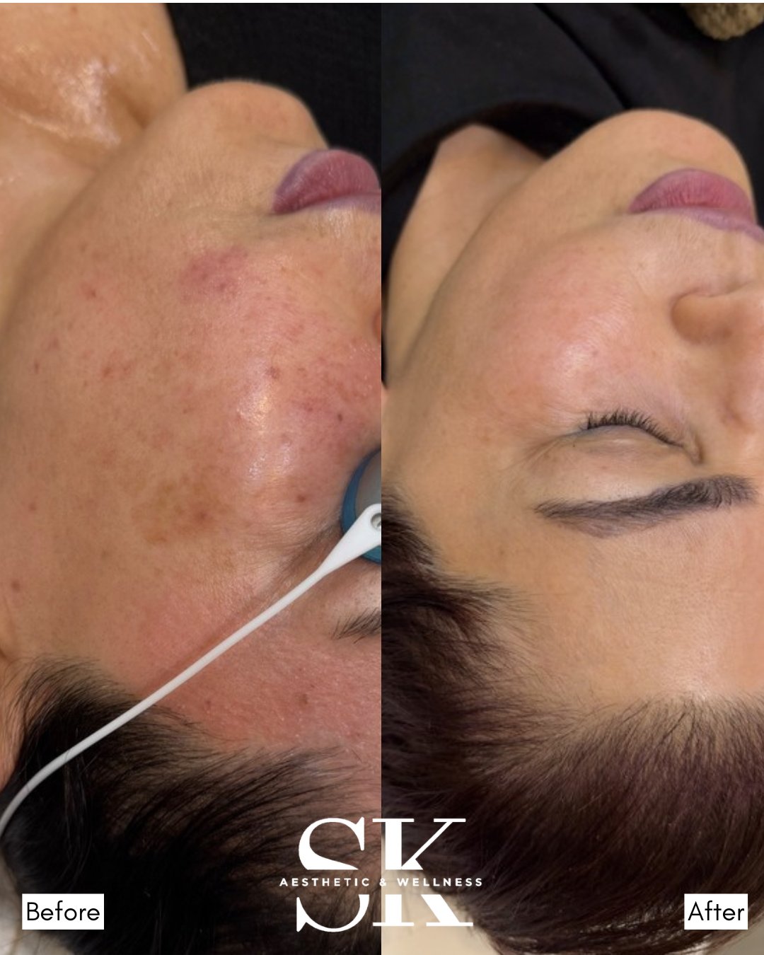 BBL and HALO before and after — SK Aesthetic and Wellness patient