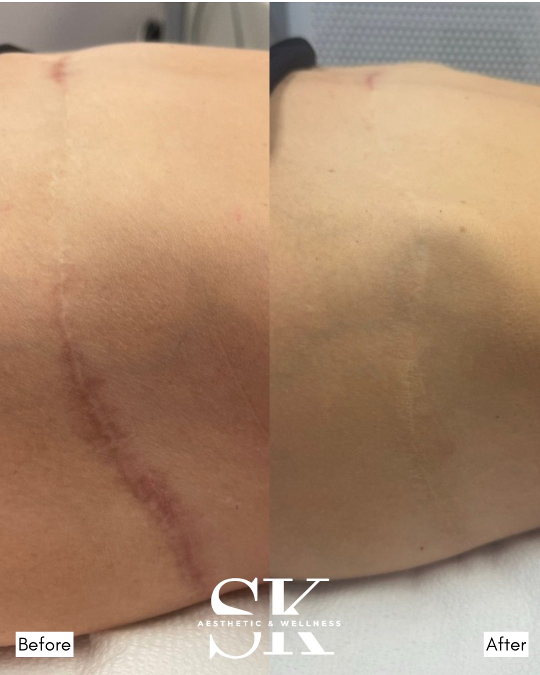 Scar camouflage before and after — SK Aesthetic and Wellness patient
