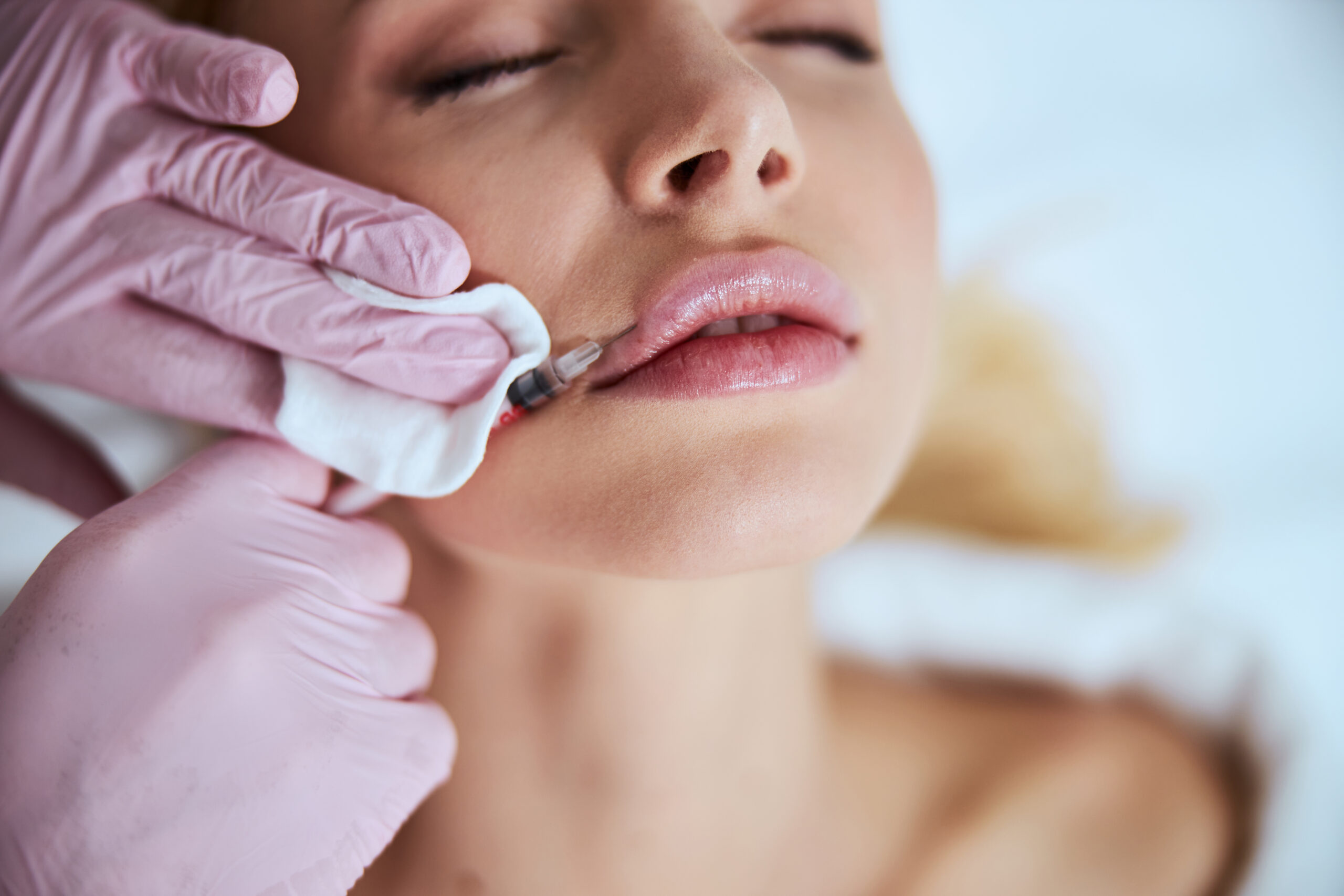 Filler dissolving with Hylenex in Vienna, VA