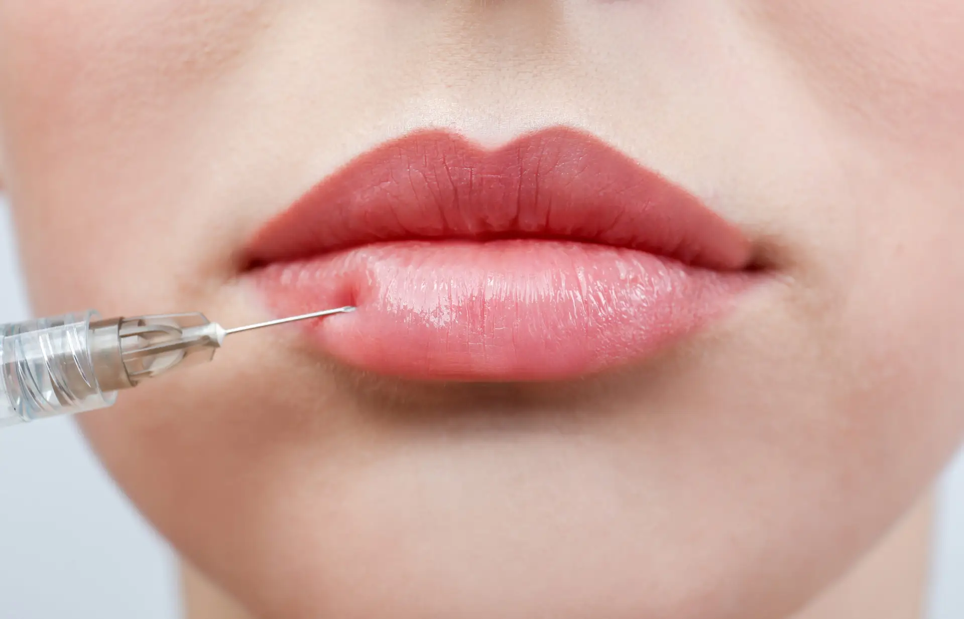Lip filler treatment at SK Aesthetic and Wellness in Vienna, VA