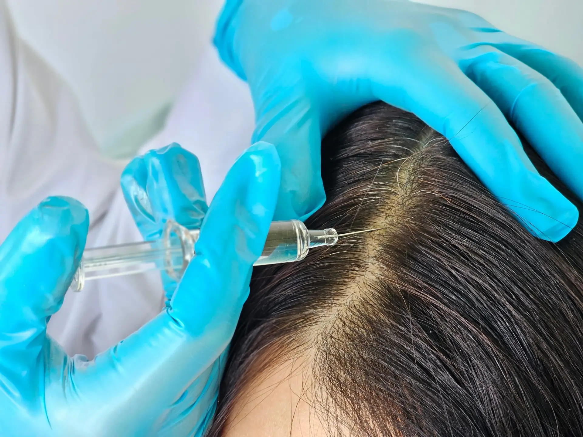 PRP hair restoration treatment for thinning hair in Vienna, VA