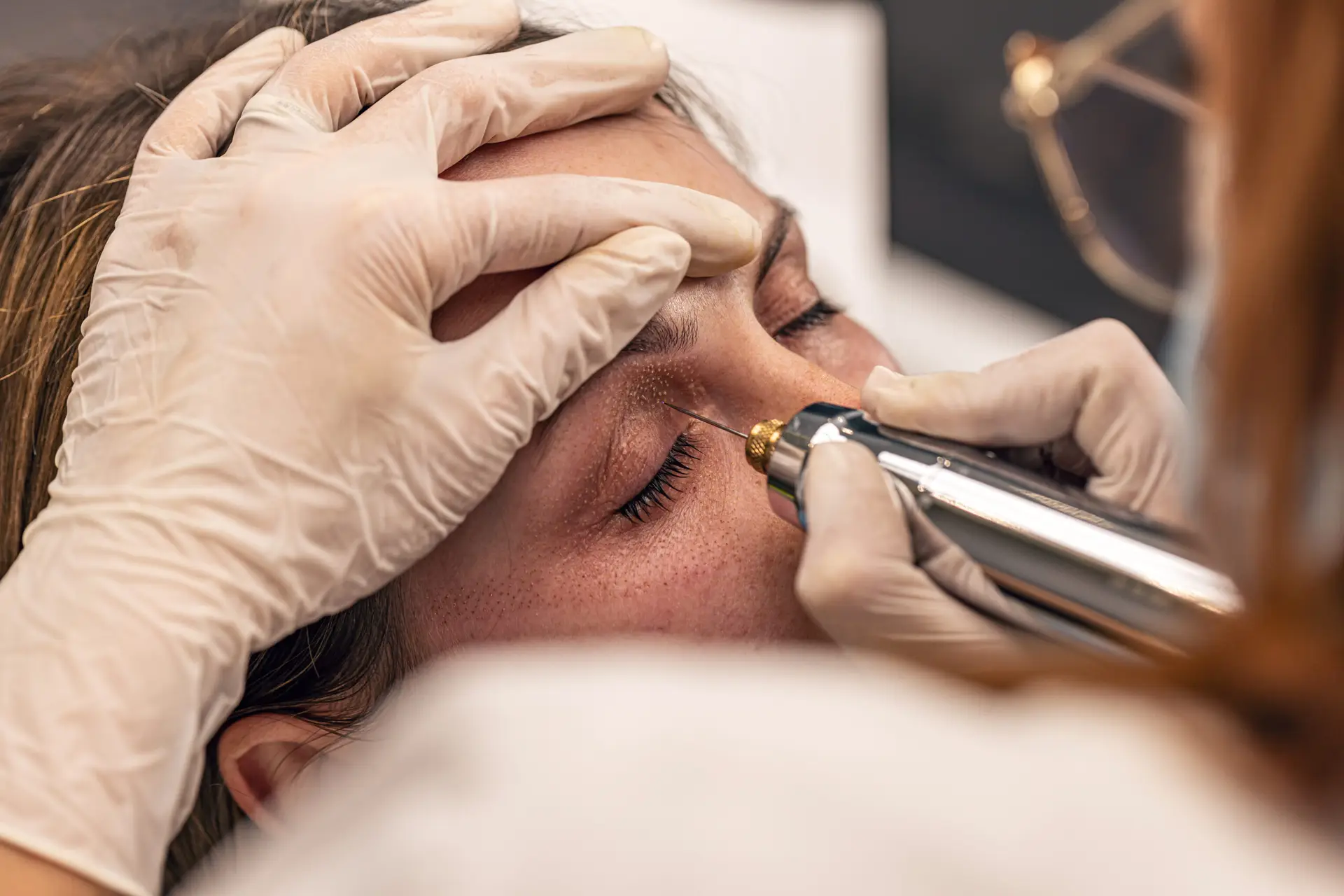 Under-eye filler treatment for hollowing and shadow in Vienna, VA